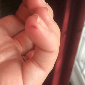 Cut with honey remedy