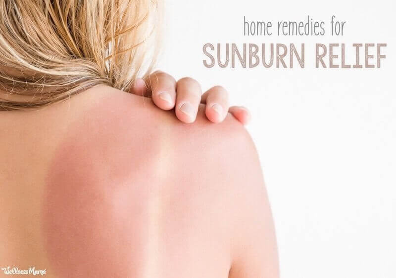 Natural Sunburn Remedies for Healthy Skin