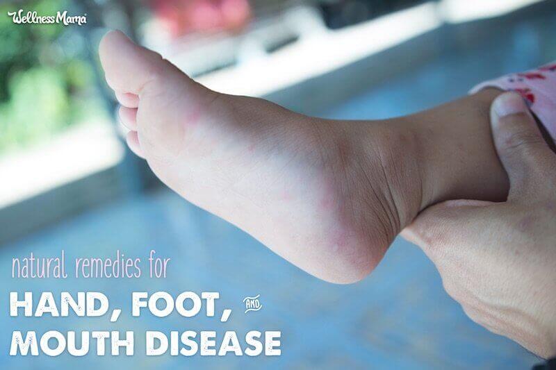 Natural Remedies for Hand Foot and Mouth Disease