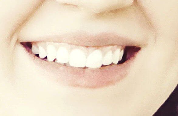 how to reduce cavities and tooth decay